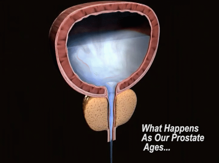 What Happens As Our Prostate Ages...